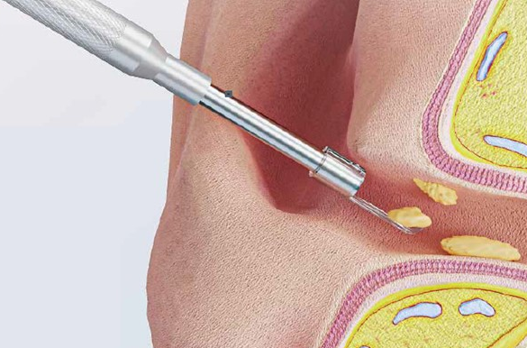 耳かきのやり過ぎを防止