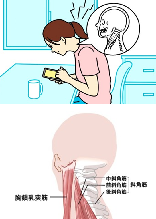スマホ首とは